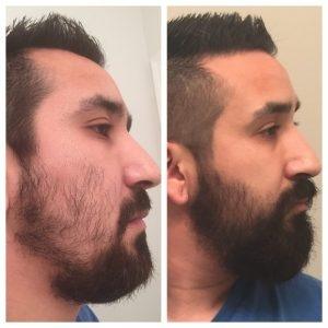 মুখভর্তি চাপ দাড়ি গজান মাত্র ১৫ দিনেই- Beard Growth Oil-UAE image 3